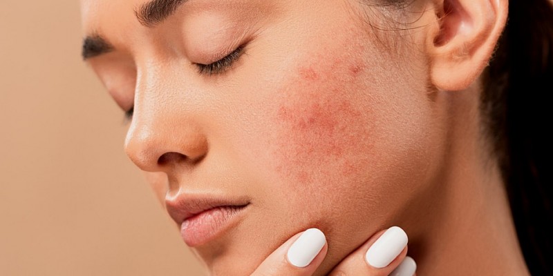 SOS : zorgt je mondmasker voor acné? 